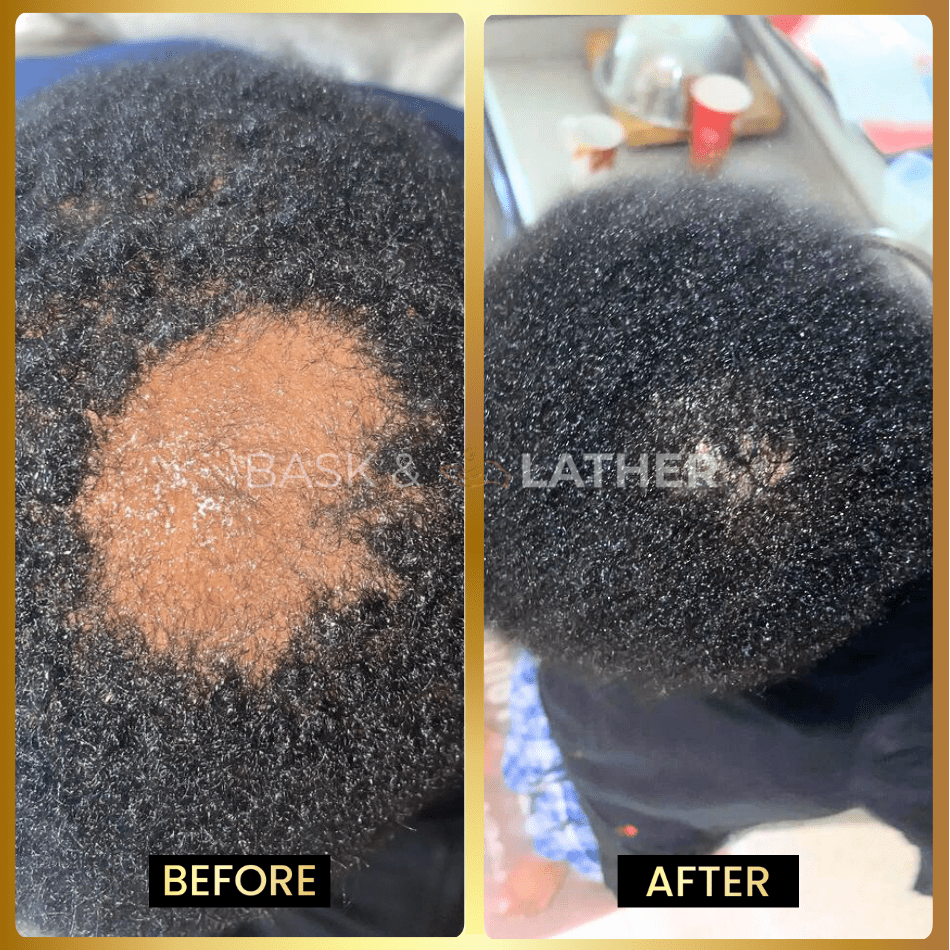 Scalp Stimulator- 3 Month Supply
